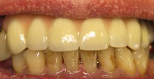 What To Avoid For Whiter Teeth 2
